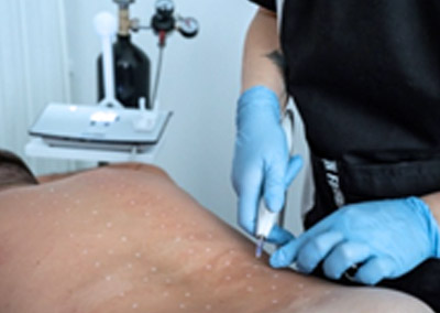 Карбокситерапия